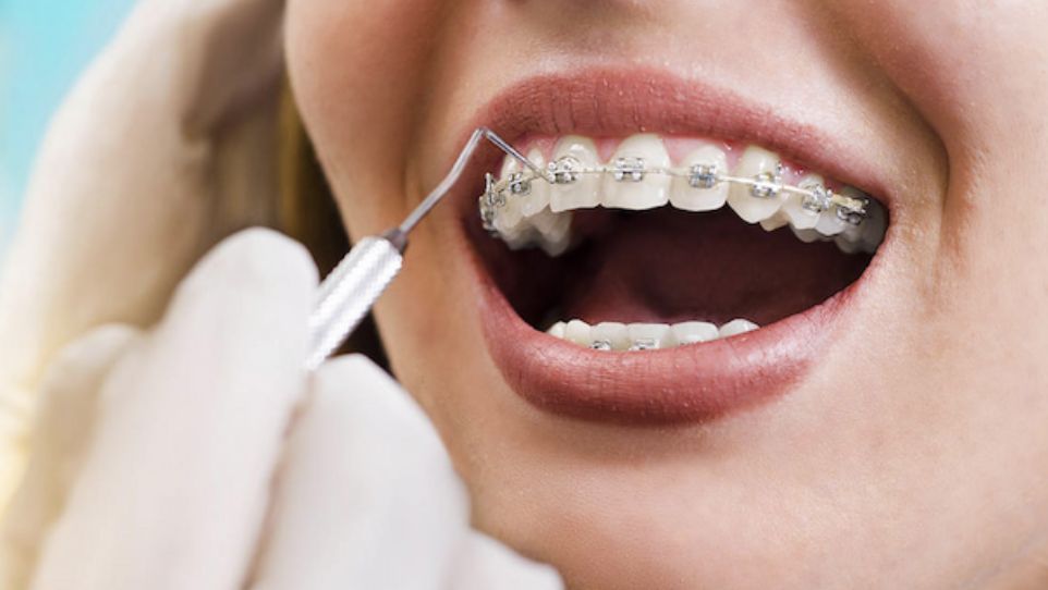 apparecchio dentale a Lucca