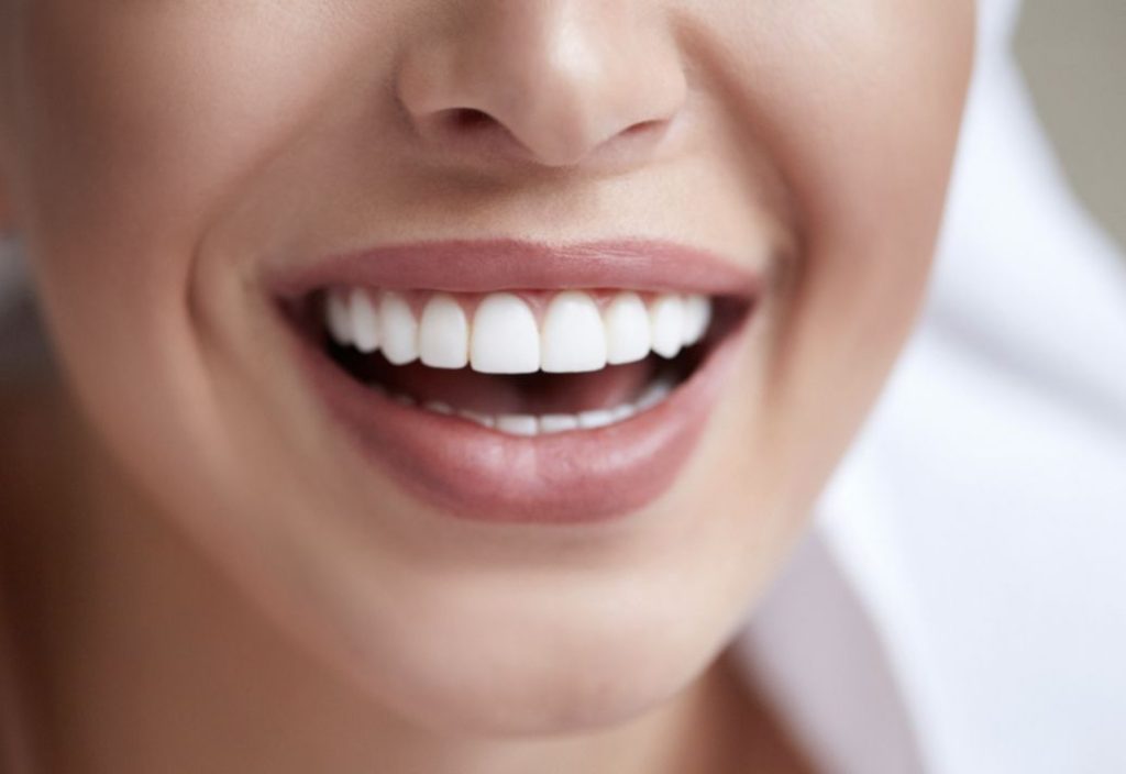 Faccette dentali a Lucca