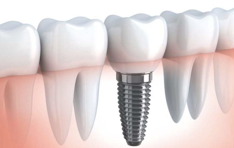 in cosa consiste un impianto dentale