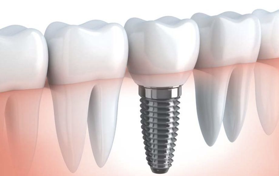 In cosa consiste un impianto dentale: guida completa per un trattamento efficace 1 in cosa consiste un impianto dentale